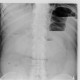 Bowel obstruction, carcinoma of sigmoid colon, SBO, ileus, colorectal cancer: X-ray - Plain radiograph